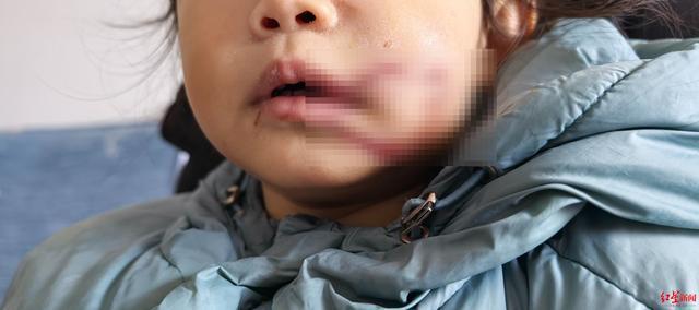 九游娛樂：1歲10個月女童小區(qū)內(nèi)被狗咬傷：監(jiān)控還原事發(fā)經(jīng)過警方初步確定為流浪狗(圖1)